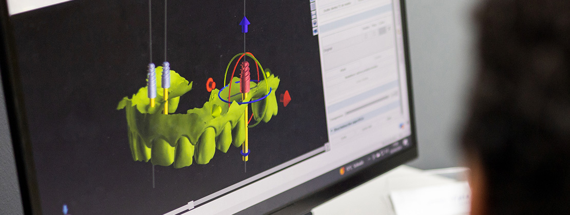 Präzise 3D-Implantologie in Flensburg – mehr erfahren »